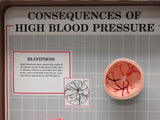 Health Edco 3D Display Consequences of High Blood Pressure Education Suitcase